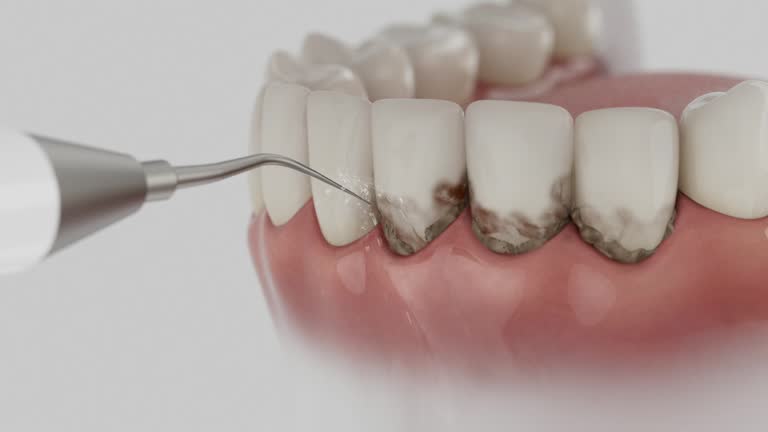 Reliable Tooth Extraction contractor in Kalamazoo, MI by Smile Center Dentistry